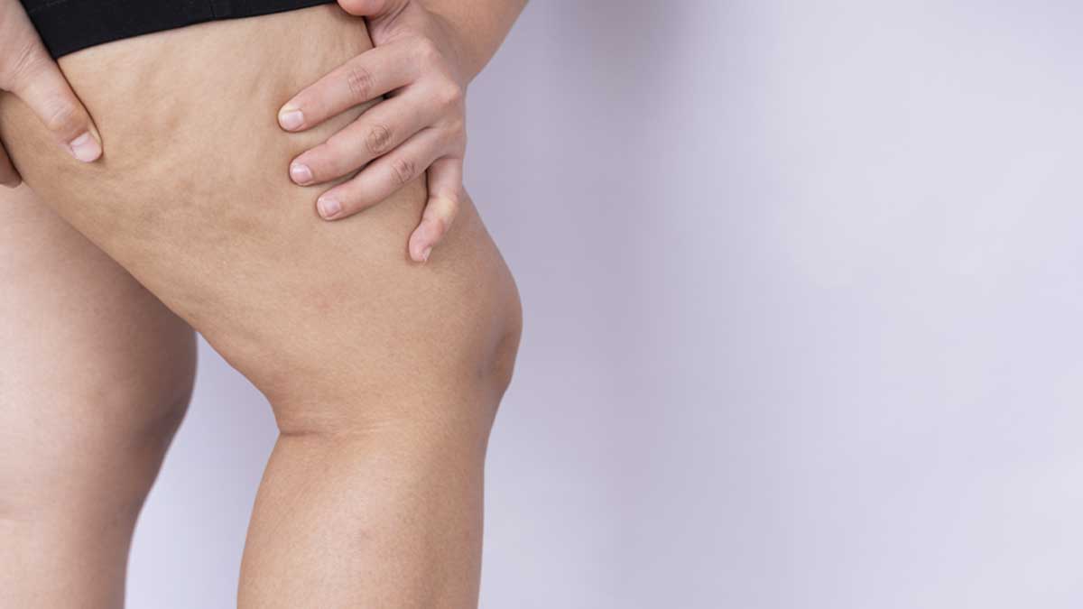 What Is Lipedema