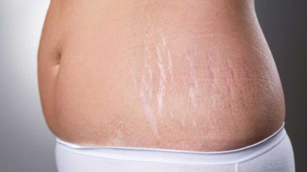Exploring the treatment of stretch marks with the help of Garment