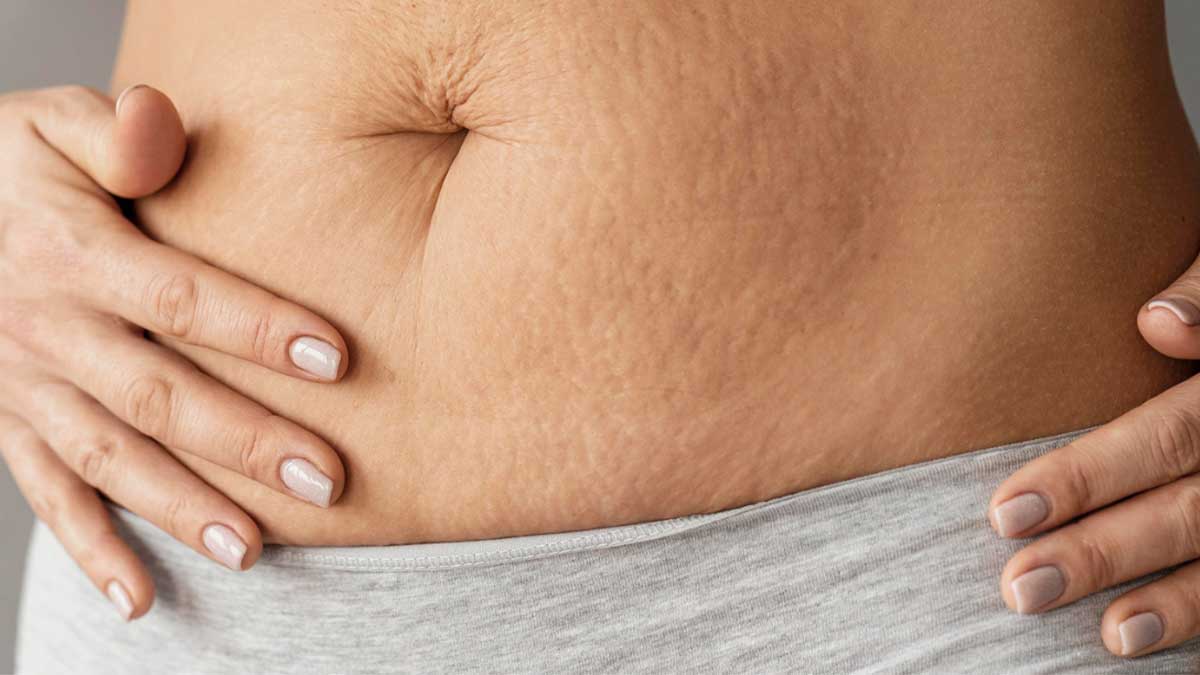 treatment of stretch marks with the help of Garment