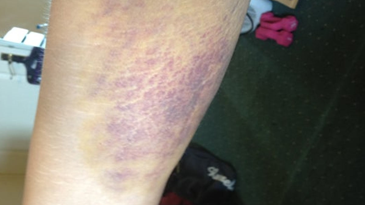 Timing and Duration of Bruising