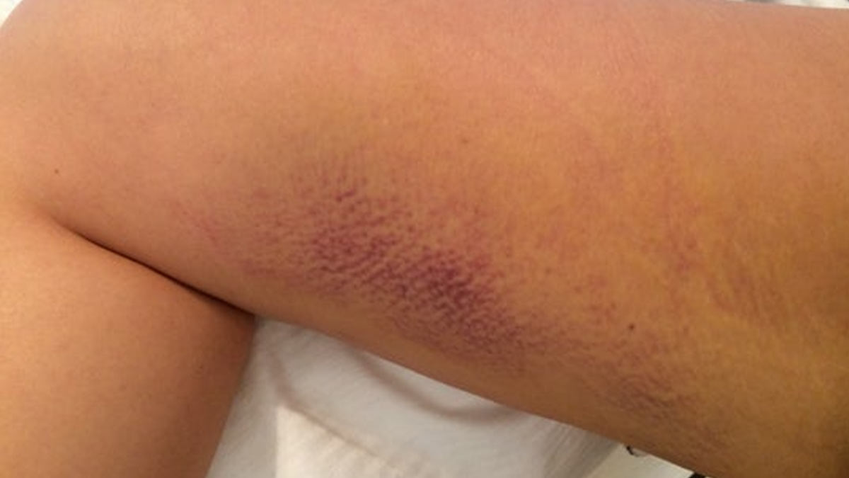 When to Be Concerned About Bruising?