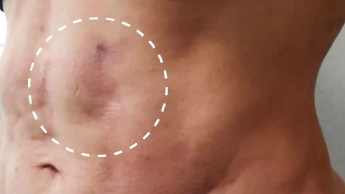 easons for bruising after liposuction