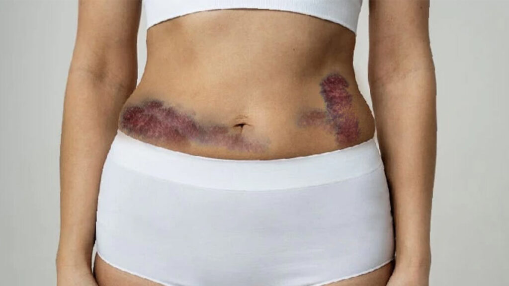 easons for bruising after liposuction